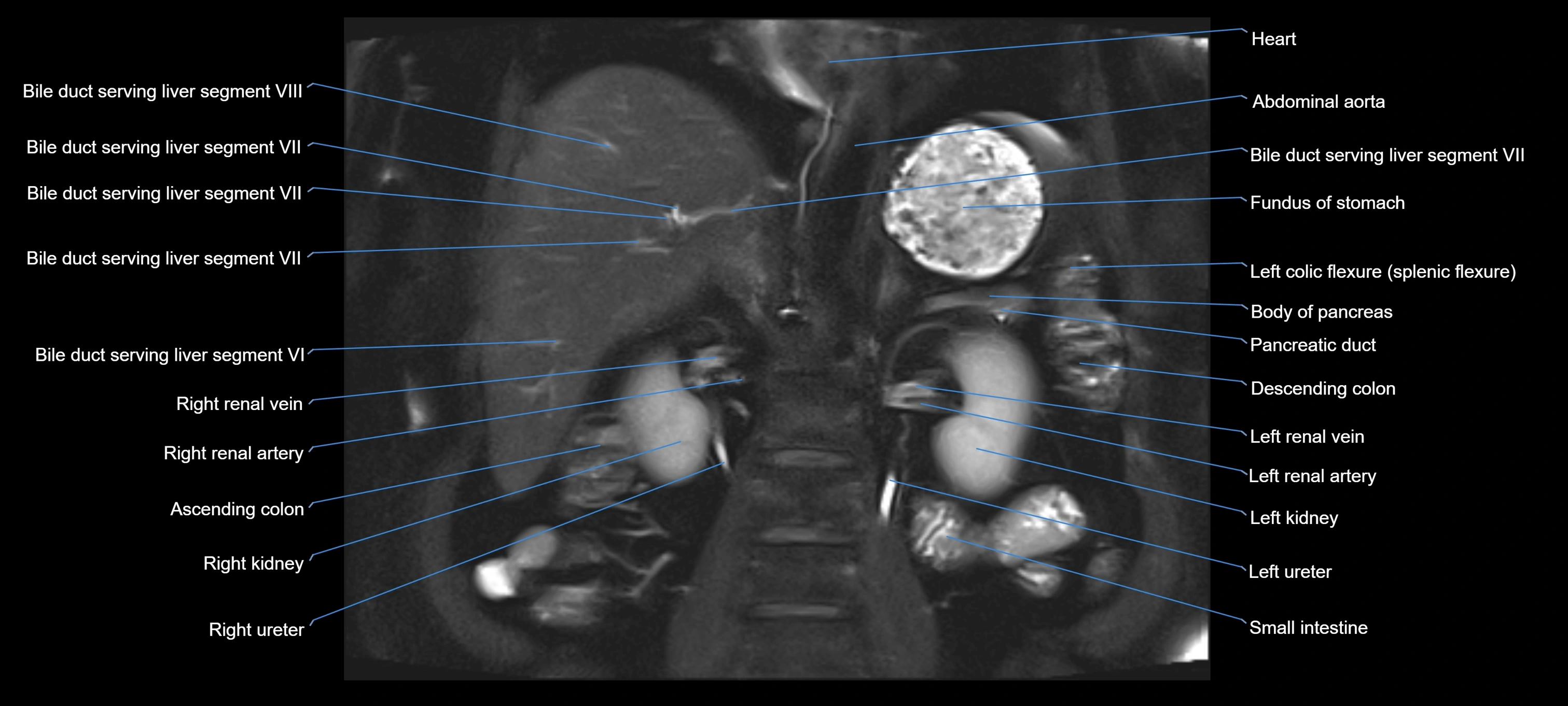 MRI MRCP coronal cross sectional 3T radiology  image-img-00001-00017.webp